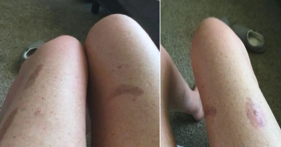 meghan-markle-bath-salts-injuries-1746709510563_e07d2.jpg
